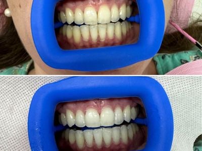 Keep Smiling Professional Teeth Whitening & tooth gems